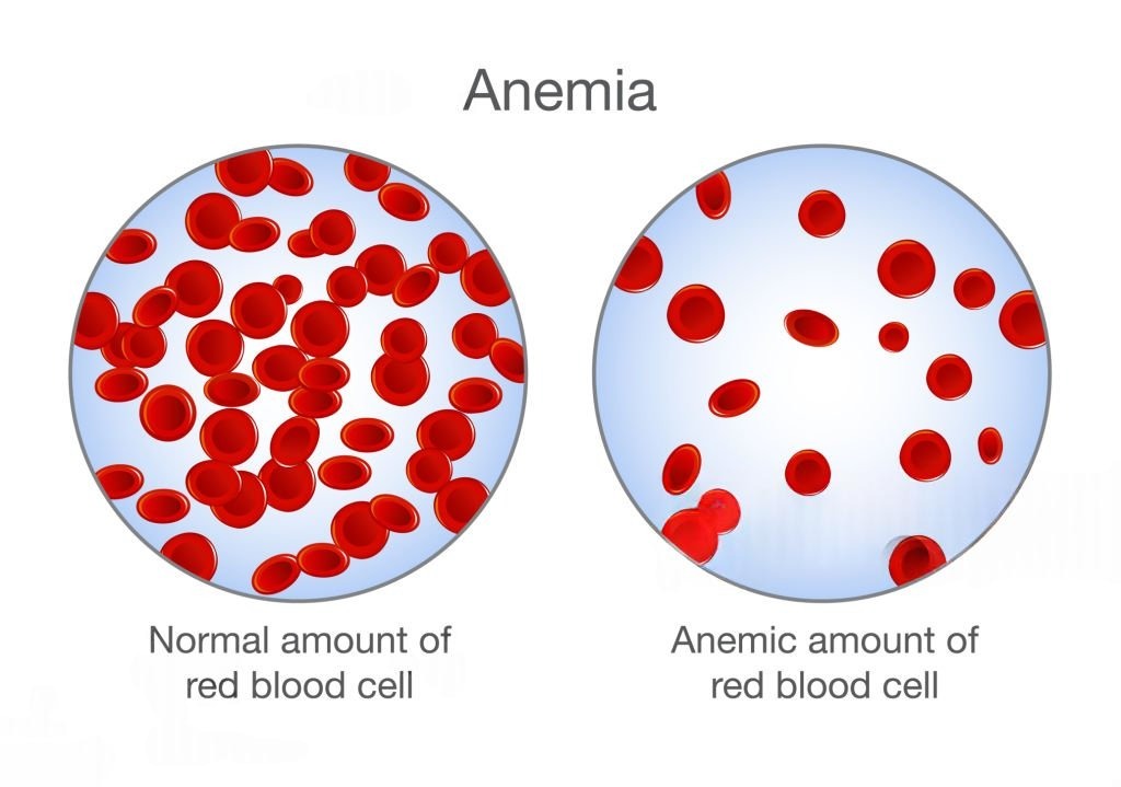 Anemia