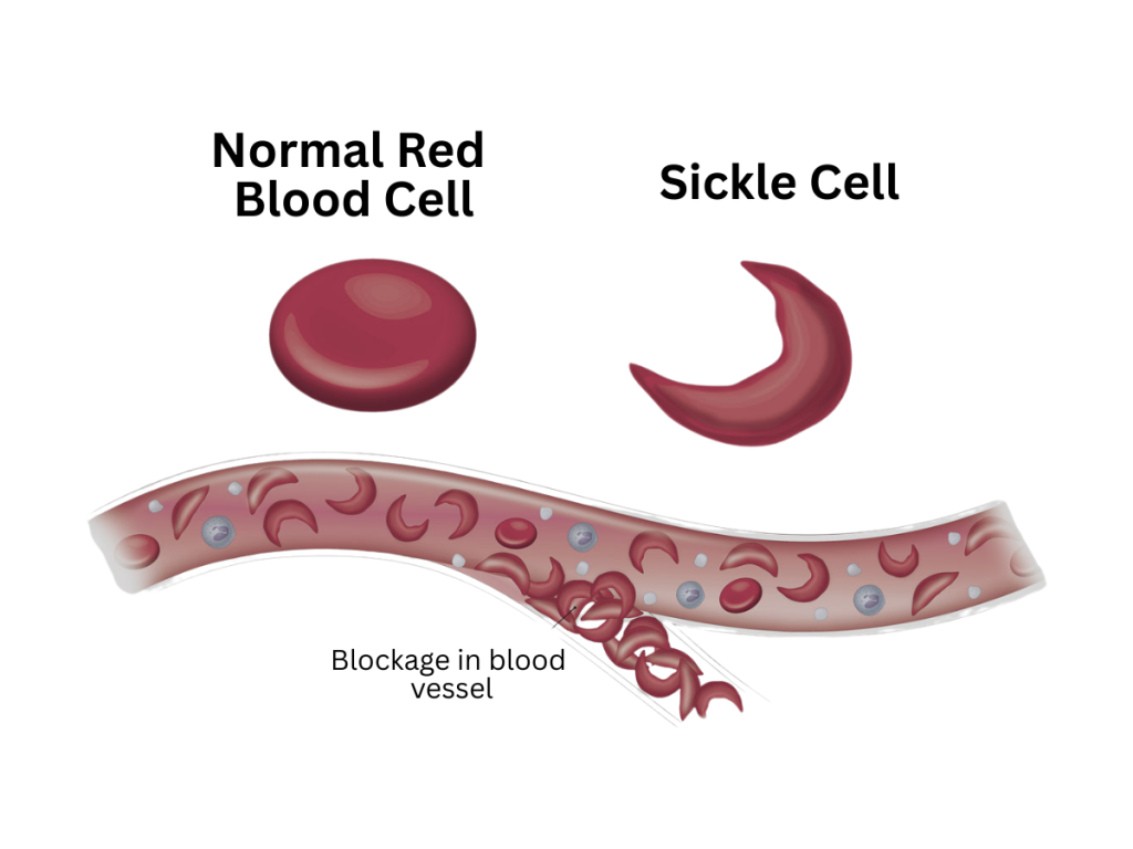 Sicke Cell Anemia
