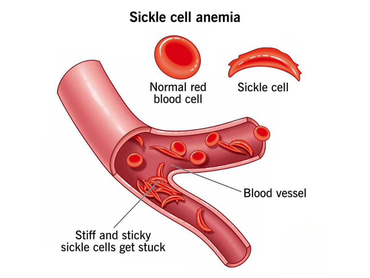 Sickel Cell Anemia