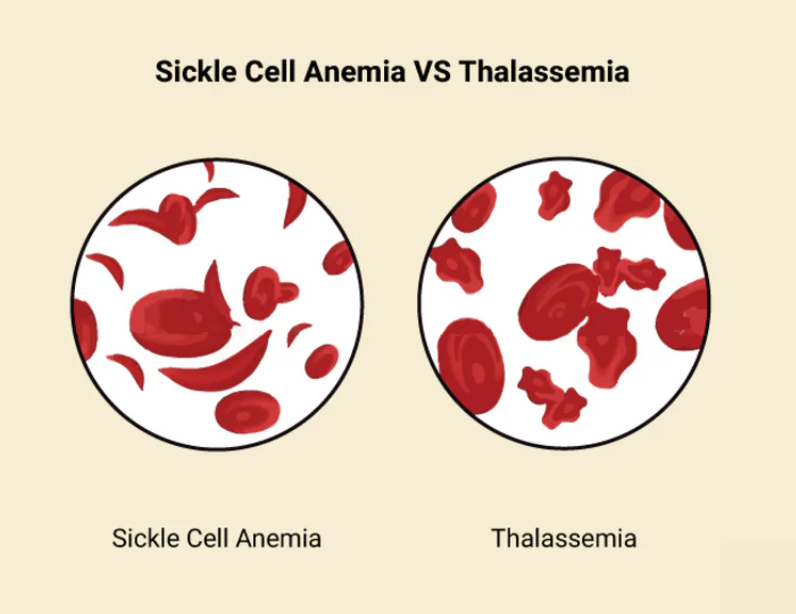 sickle cell anemia vs. thalassemia