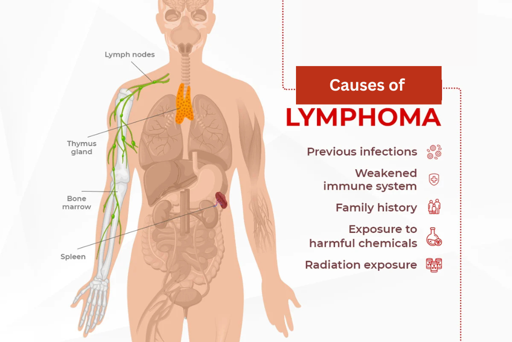 Lymphoma in Children: Symptoms, Causes and Treatment Guide