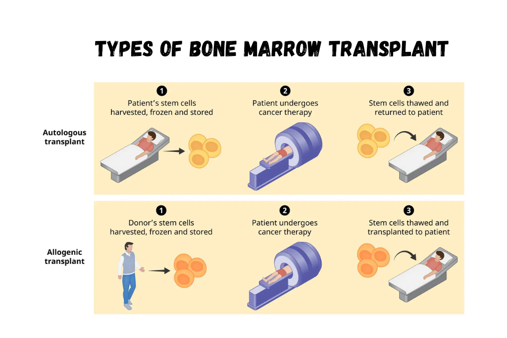 Bone Marrow Transplant: A Life-Saving Treatment for Children