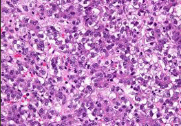 Hepatoblastoma
