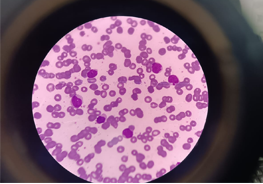 leukemia