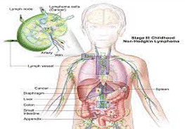 non-hodgkins-lymphoma