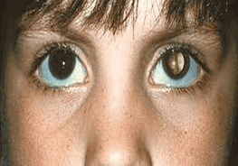 retinoblastoma